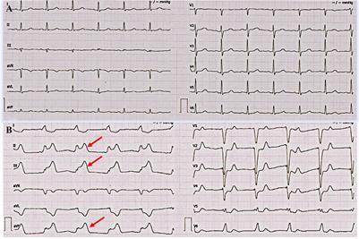 Case report: Pacemaker lost capture after acute myocardial infarction in a patient with left circumflex coronary artery occlusion